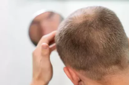Comprendre, prévenir et traiter la chute de cheveux héréditaire homme